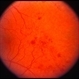 Peripheral retinal nonperfusion, capillary abnormalities, retinal microaneurysms, and  intraretinal hemorrhage